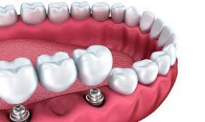 Porcelain Crowns and Bridges - Rifats Dental