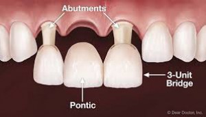 Dental Bridge - Avenue Dental Care