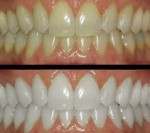 Bleach - Johnsons Place Dental...
