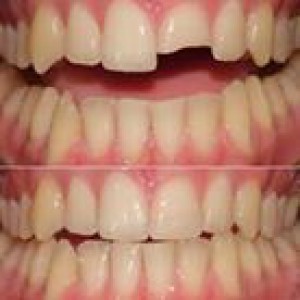 Composite filling - Johnsons Place Dental Lab
