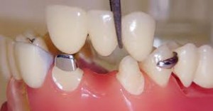 Crown Bridge - Avenue Dental Care