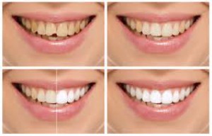 Cosmetic Dentistry - Rifats Dental