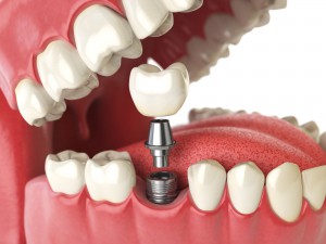 Dental Implants - Aiko Dental and Implant Center