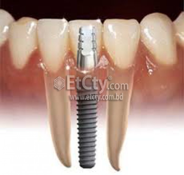 Dental Implant In Bangladesh