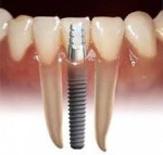 Dental Implant In Bangladesh