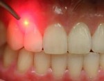 Teeth Cleaning(Scaling) - City...