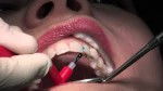 Composite Filling - Avenue...