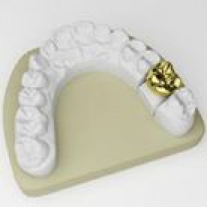Ms gold crown - Johnsons Place Dental Lab