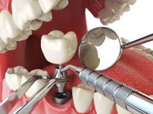 Dental implant - Avenue Dental Care