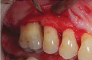 Periodontal Surgery - Rifats Dental