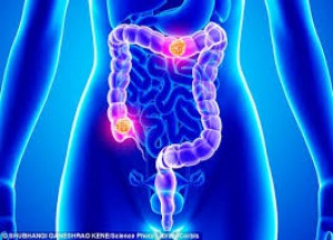 Colon Cancer - Eden Multi-Care Hospital