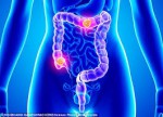 Colon Cancer - Eden Multi-Care...