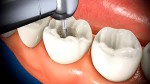 Root Canal - Avenue Dental...