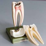 Root Canal Therapy - City...