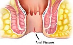 ANAL FISSURE - Eden Multi-Care...