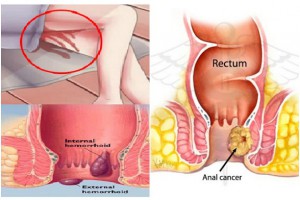 RECTUM CANCER - Eden Multi-Care Hospital