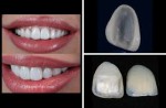 Dental Veneer - Avenue Dental...