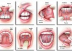 Oral Cancer - Avenue Dental...