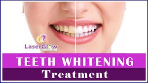 Tooth Whitening - Rifats Dental
