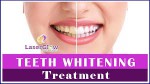 Tooth Whitening - Rifats Dental
