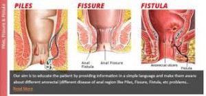 ANAL FISTULA - Eden Multi-Care Hospital