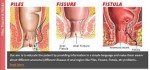 ANAL FISTULA - Eden Multi-Care...
